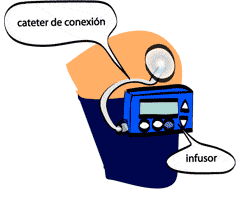 cateter de conexión, infusor